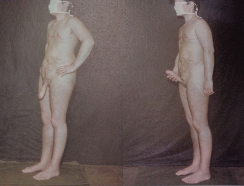 Фотографии влагалища после хирургического изменения пола: развитие анатомии и видимые изменения.